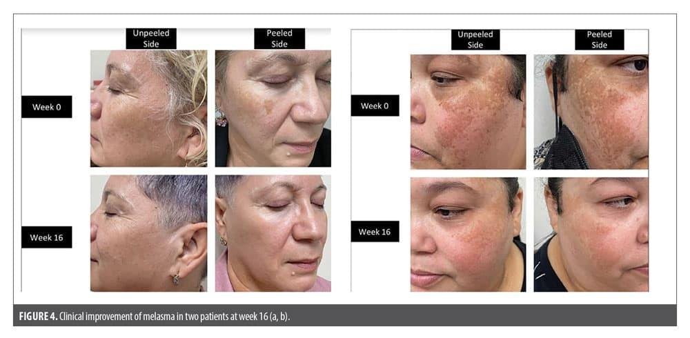 Melasma